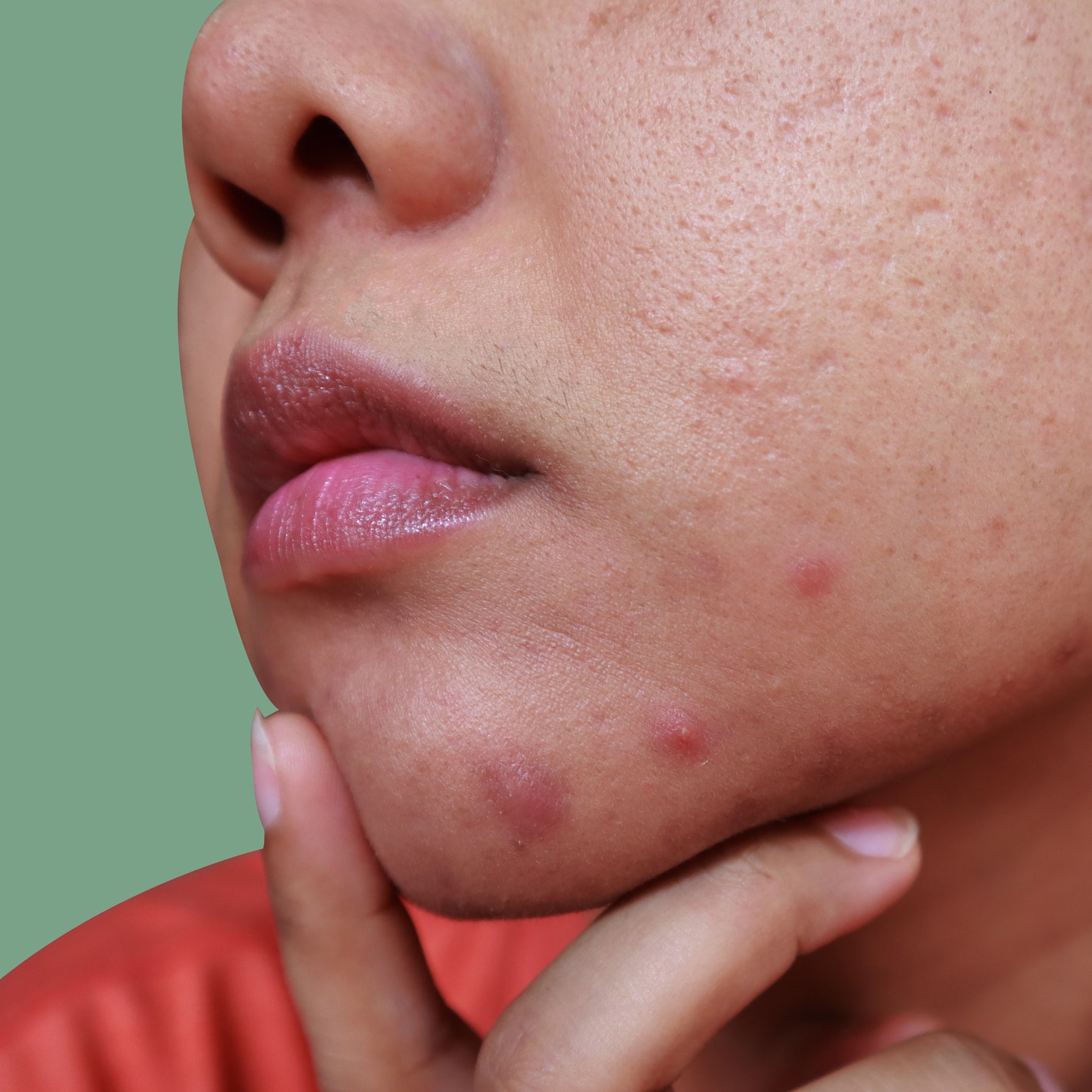 I’m a Grown-Ass Adult&-Why Is Chin Acne Still Ruining My Life?